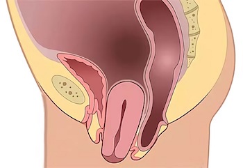 Лечение опущения и выпадения матки. Операции при опущении и выпадении матки